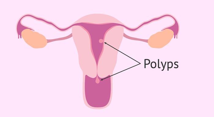 POLYP CỔ TỬ CUNG