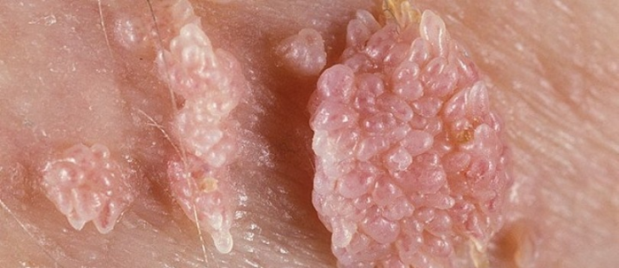 MỤN CÓC SINH DỤC ( GENITAL WARTS)